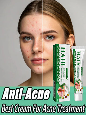 3RD Anti-Acne Cream Effective Removes Skin Nodules Pustules Cysts Papules Blackheads Men and Women Acne Skin Care Essence Cream