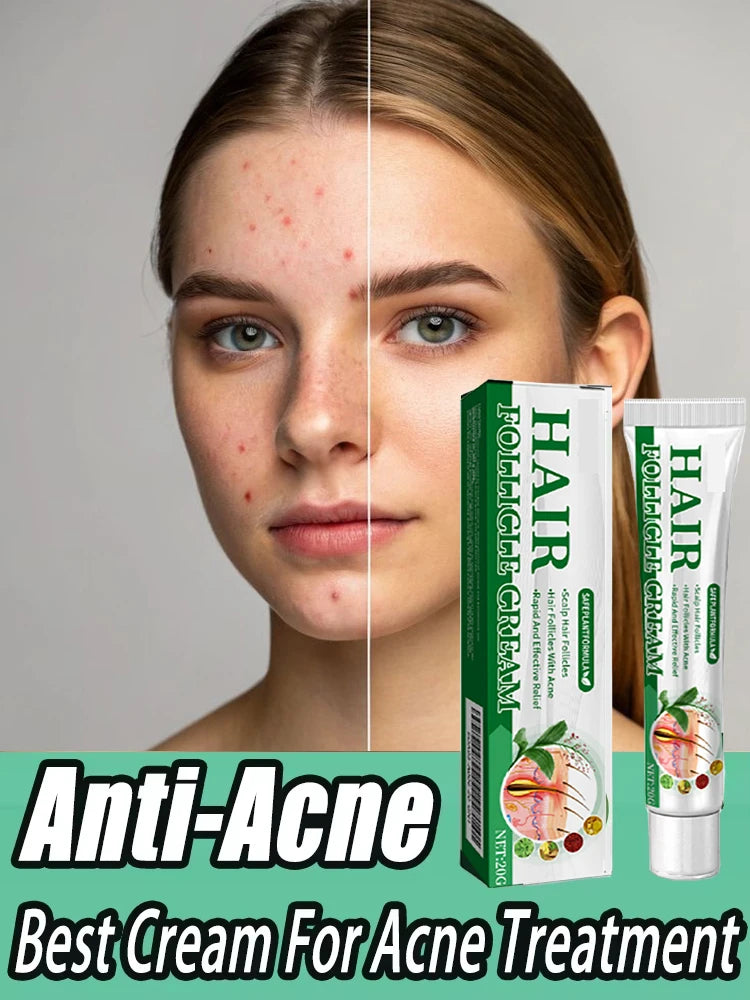 3RD Anti-Acne Cream Effective Removes Skin Nodules Pustules Cysts Papules Blackheads Men and Women Acne Skin Care Essence Cream
