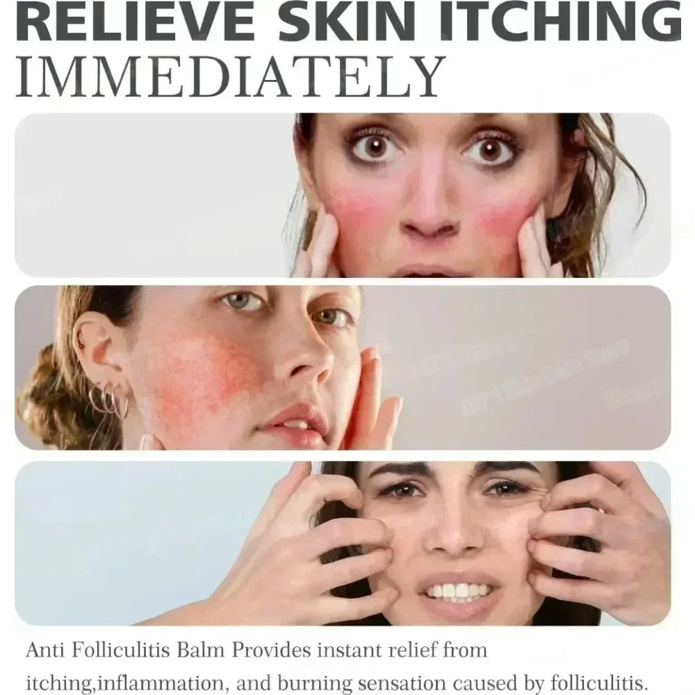 3RD Anti-Acne Cream Effective Removes Skin Nodules Pustules Cysts Papules Blackheads Men and Women Acne Skin Care Essence Cream