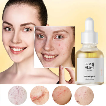 Propolis And Salicylic Acid Acne Treatment Essence, Pore Refining Essence, Glutathione And Niacinamide For Brighter Skin