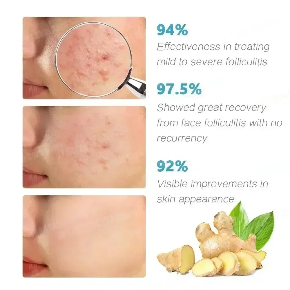 3RD Anti-Acne Cream Effective Removes Skin Nodules Pustules Cysts Papules Blackheads Men and Women Acne Skin Care Essence Cream