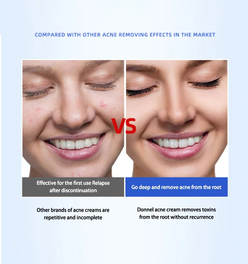 Anti-acne Treatment Cream Salicylic Acid Acne Deep Cleaning Pore Repair Pimple Spots Shrinking Oil Control Moisturizer Skin Care