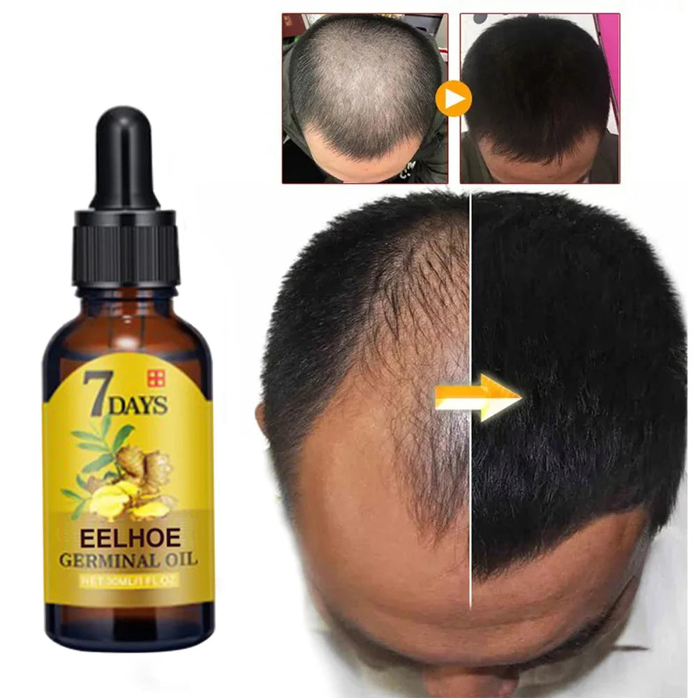EELHOE Ginger Hair Growth Oil for Scalp Massage Hair Follicle Treatment Hair Care Germinal Essence for Regrowth & Loss Treatment