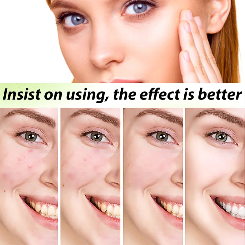 3RD Anti-Acne Cream Effective Removes Skin Nodules Pustules Cysts Papules Blackheads Men and Women Acne Skin Care Essence Cream