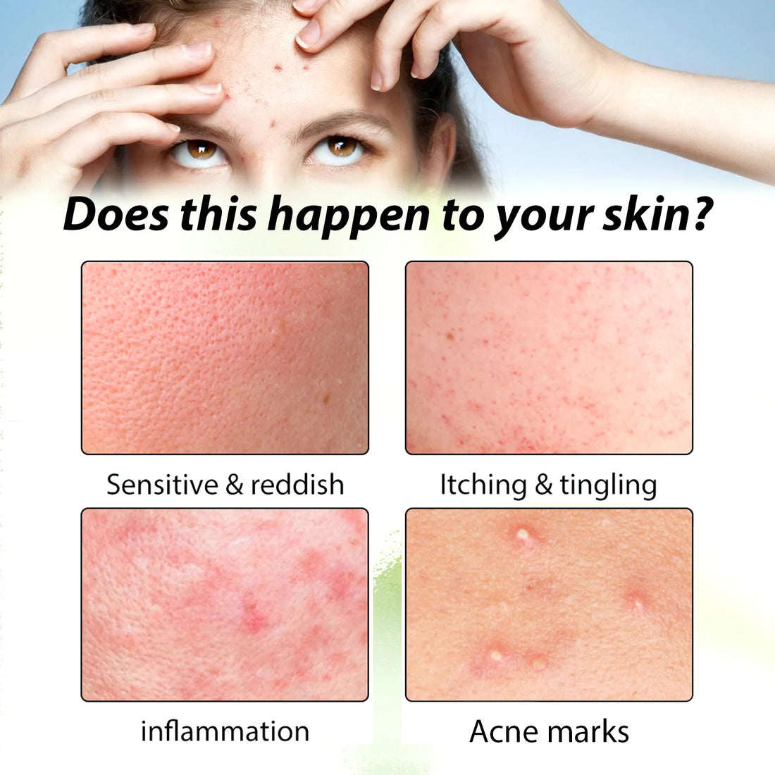3RD Anti-Acne Cream Effective Removes Skin Nodules Pustules Cysts Papules Blackheads Men and Women Acne Skin Care Essence Cream
